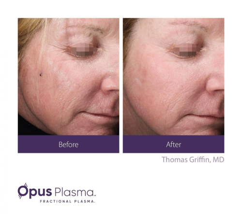 Opus Plasma before and after 2