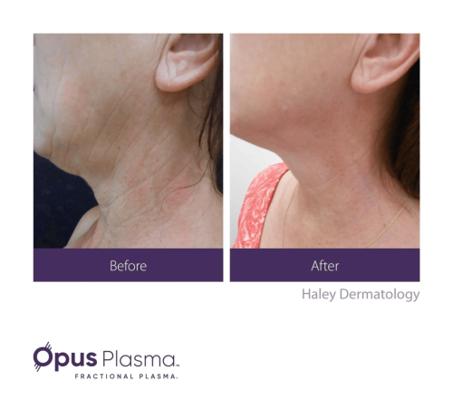 Opus Plasma before and after 1