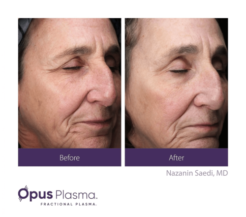 Opus Plasma before and after 3