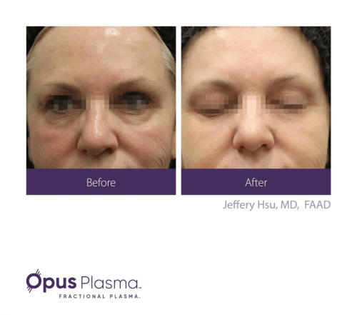 Opus Plasma before and after 4