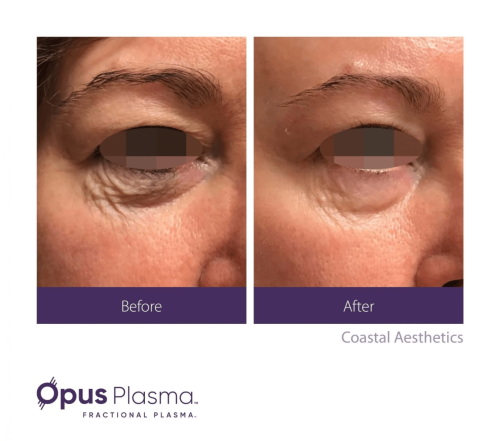 Opus Plasma before and after 5