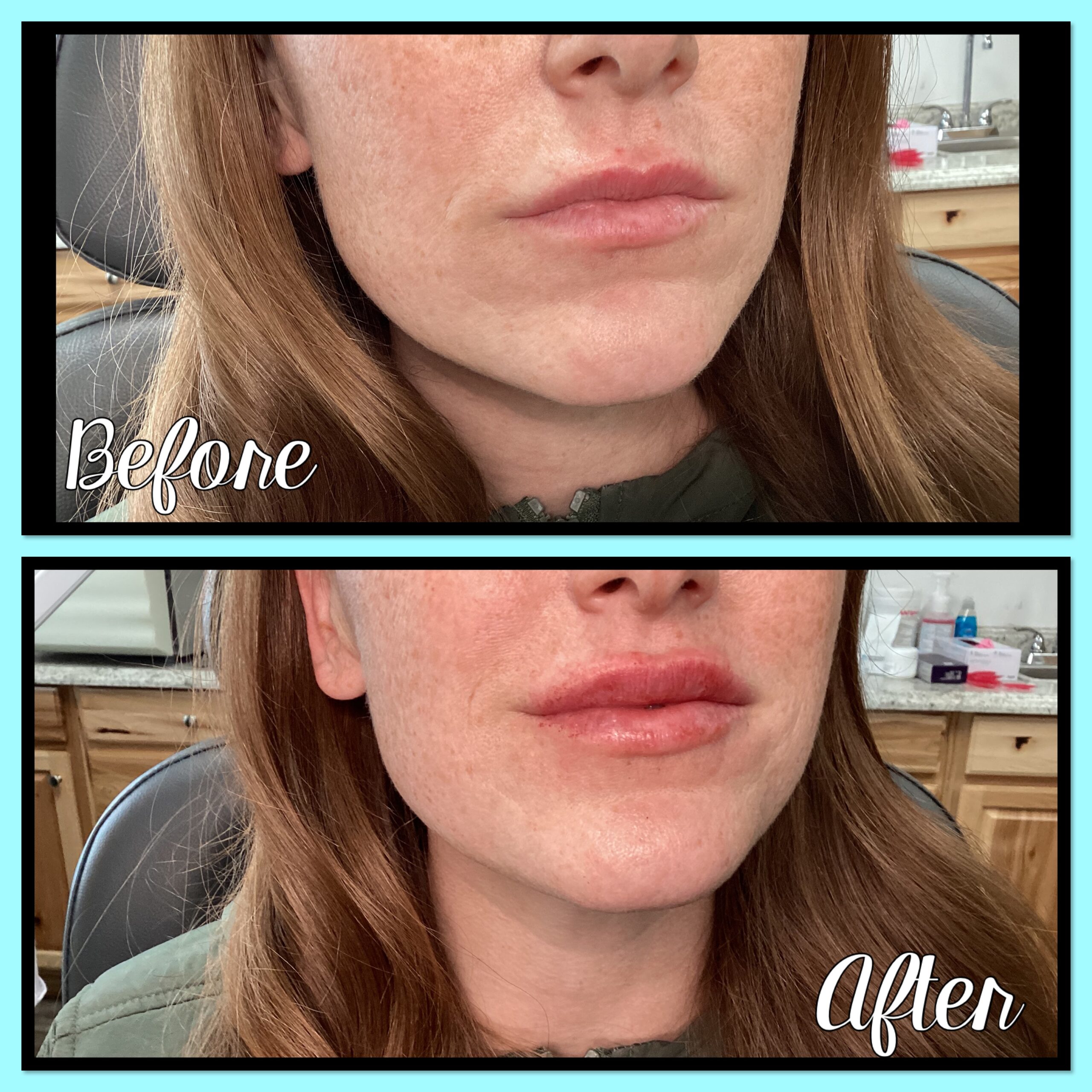 Restylane before and after result at Magic Mirror MedSpa