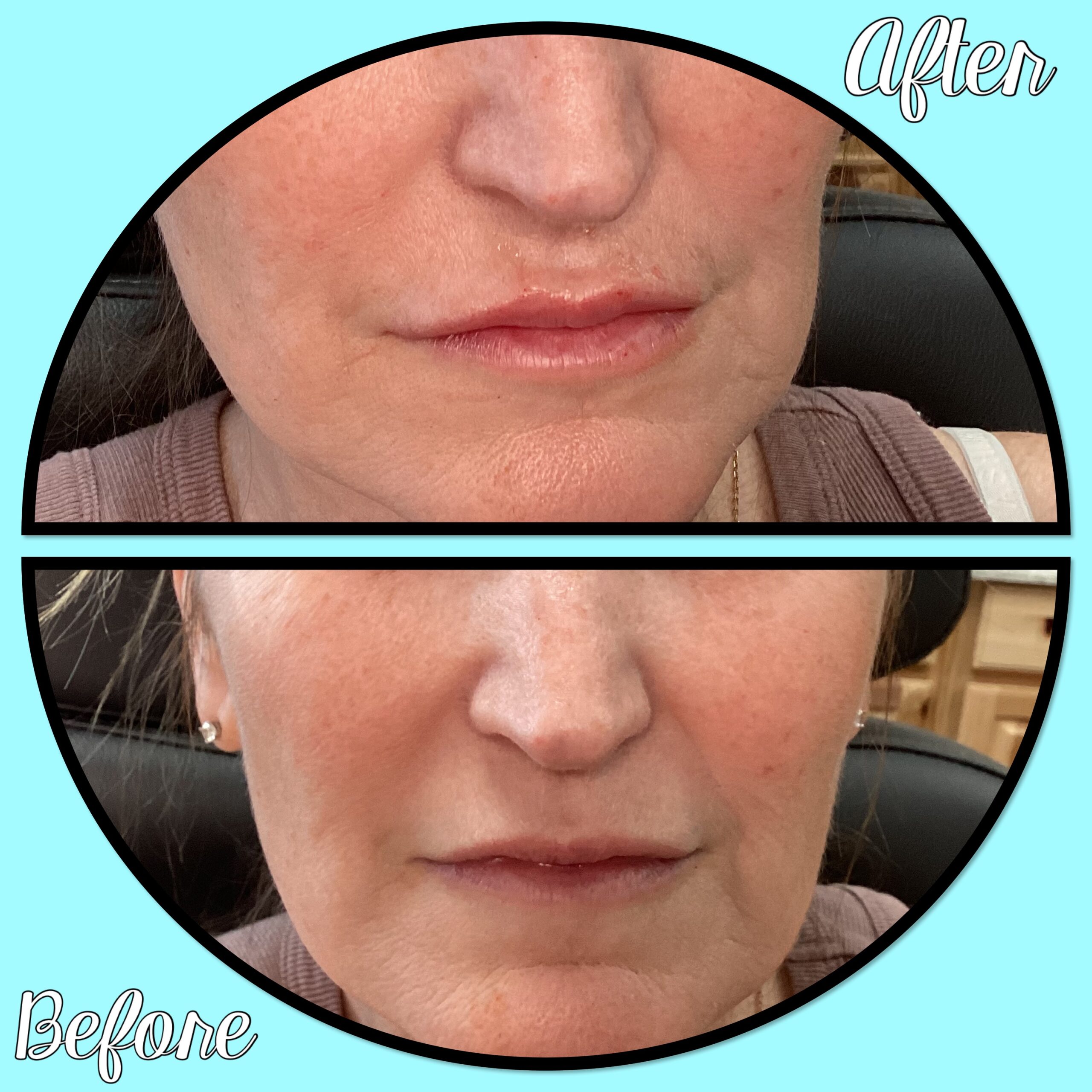 Restylane before and after facial filler result at Magic Mirror MedSpa