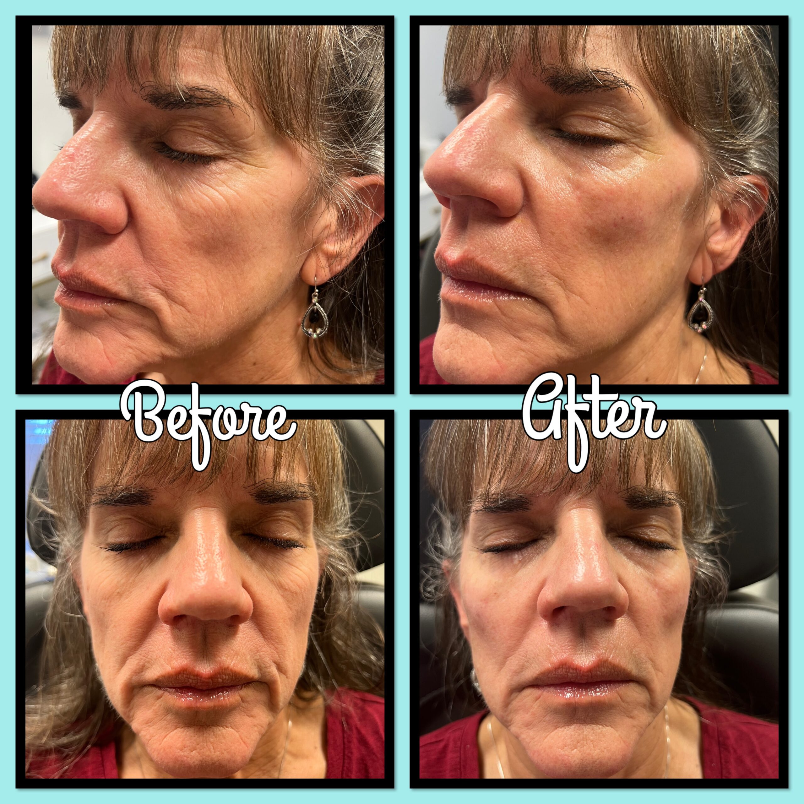 Before and after cosmetic injections at Magic Mirror MedSpa