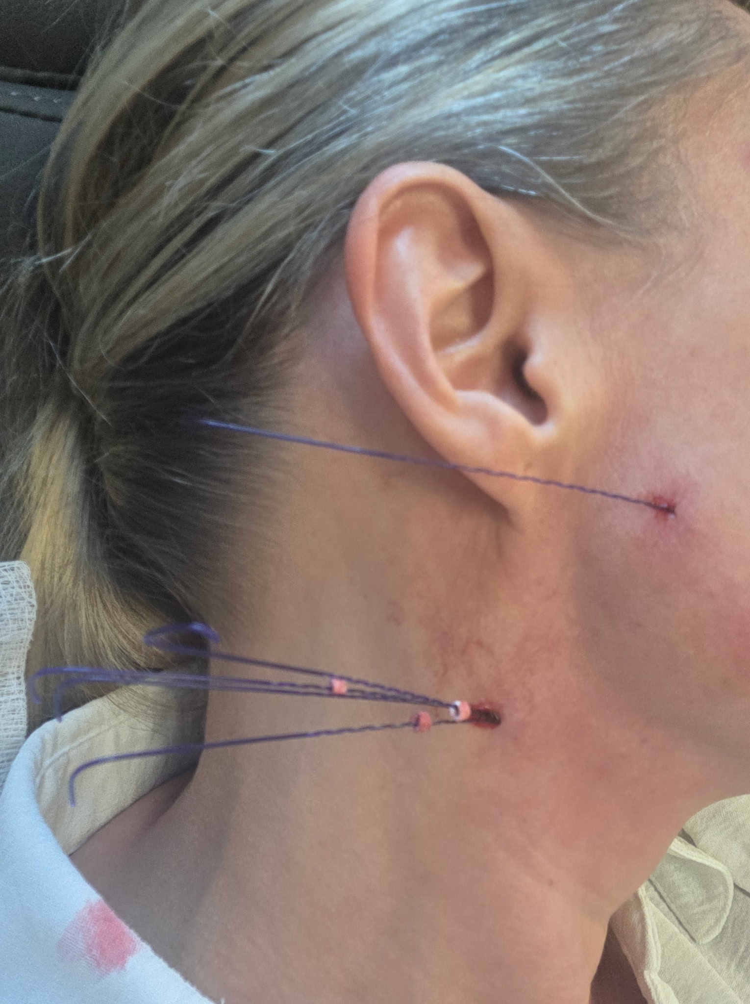 PDO Thread Lift at Magic Mirror MedSpa