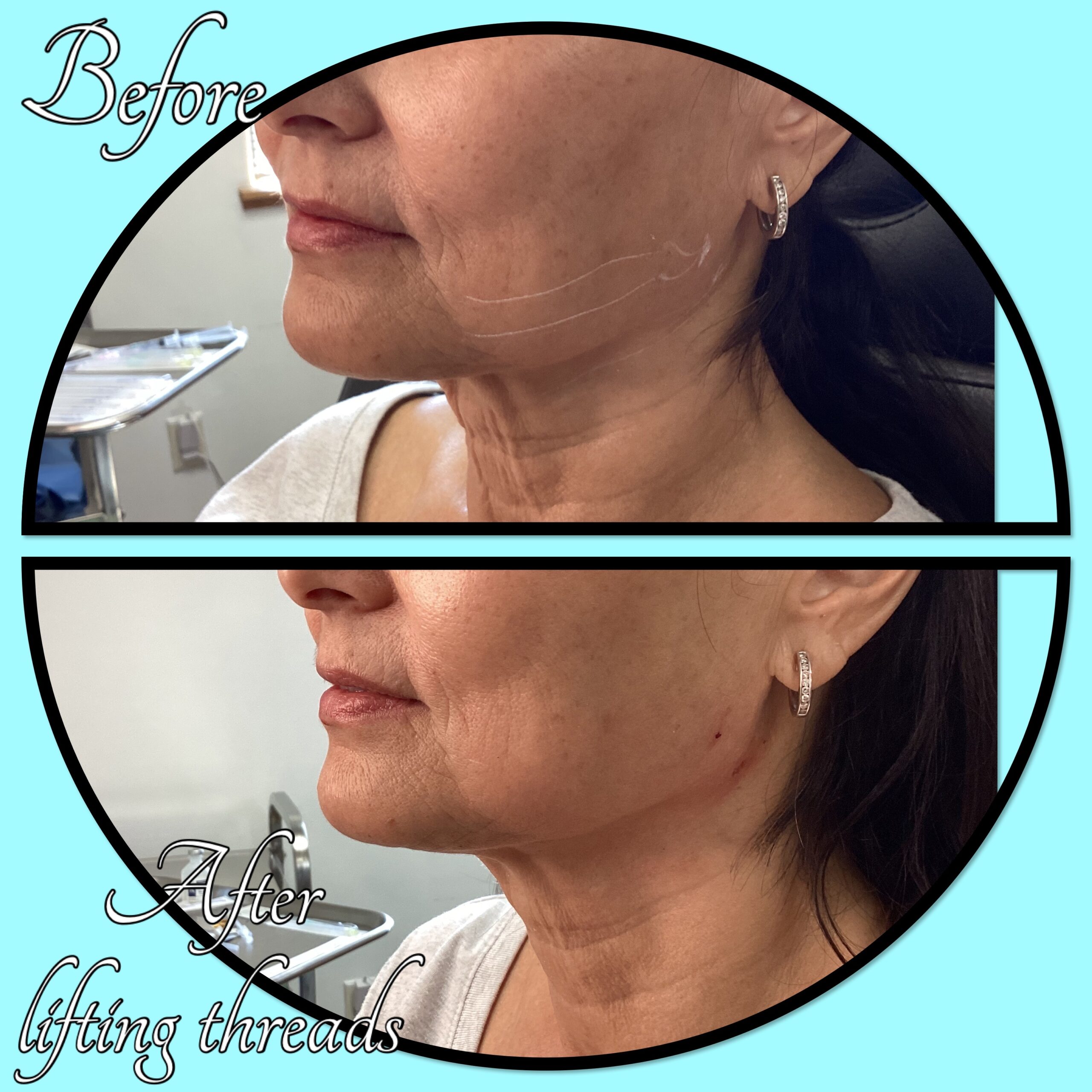 PDO Thread Lift consultation at Magic Mirror MedSpa